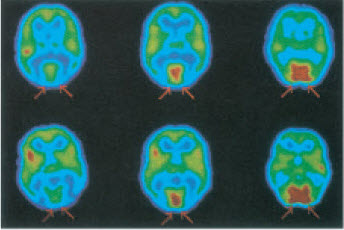 मेंदूतील कार्यक्षेत्रांचे 'स्थान संगणकीय छेददर्शन' : हक्-उद्दीपनाने प्रभावित होणारा मेंदूचा भाग वाणांनी दर्शविलेला आहे.(डावीकडे-डोळे मिटलेले असताना मध्ये व उजवीकडे - डोळे उधडल्यावर मानसिक क्रिया वाढताना)
